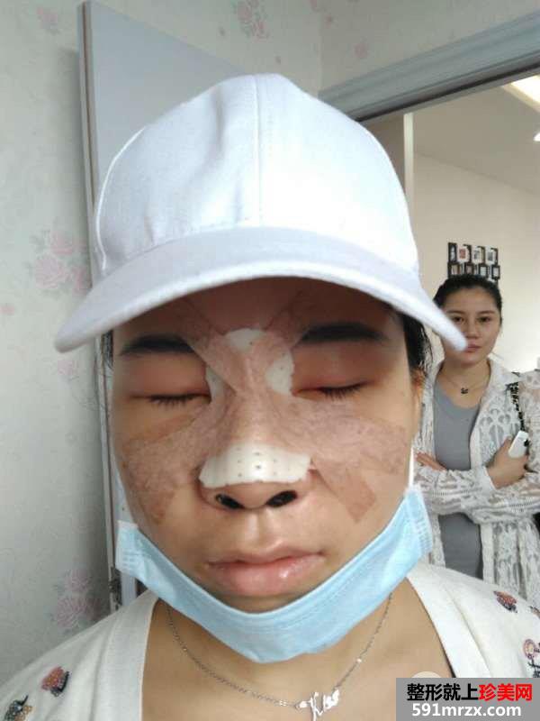 瘦脸针+综合鼻整形案例效果对比图变化惊人