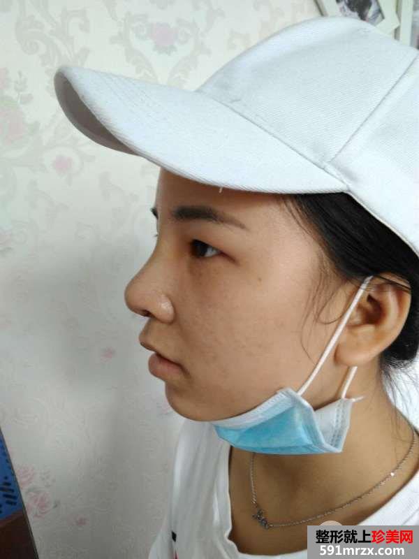 瘦脸针+综合鼻整形案例效果对比图变化惊人