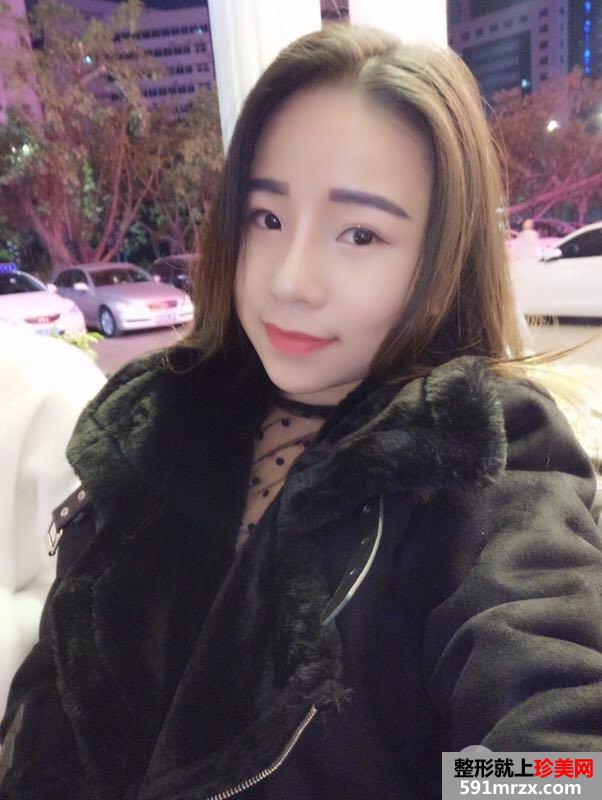 瘦脸针+综合鼻整形案例效果对比图变化惊人