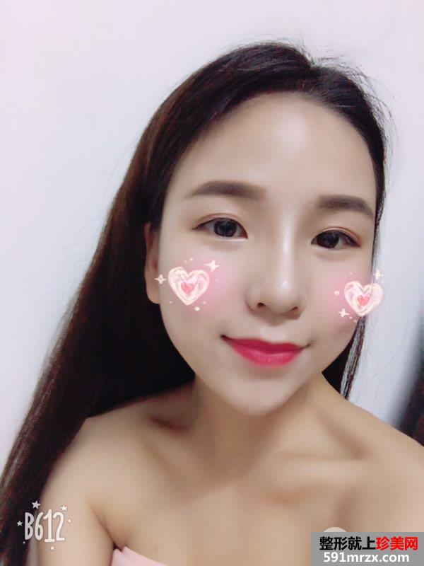 瘦脸针+综合鼻整形案例效果对比图变化惊人