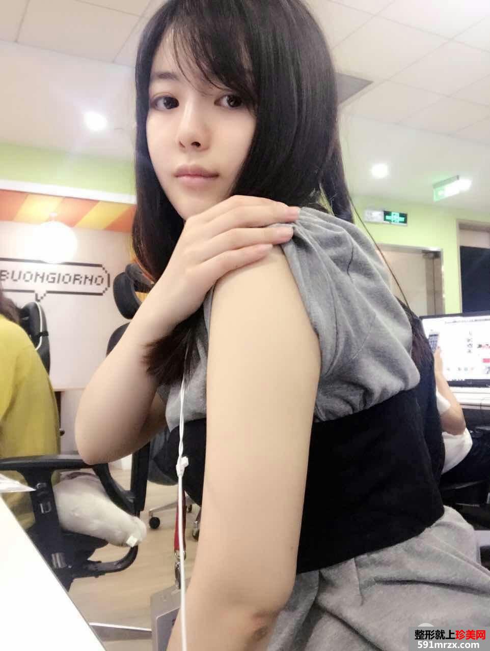 吸脂瘦手臂+面部吸脂亲身经历有图有真相，对多余脂肪说拜拜