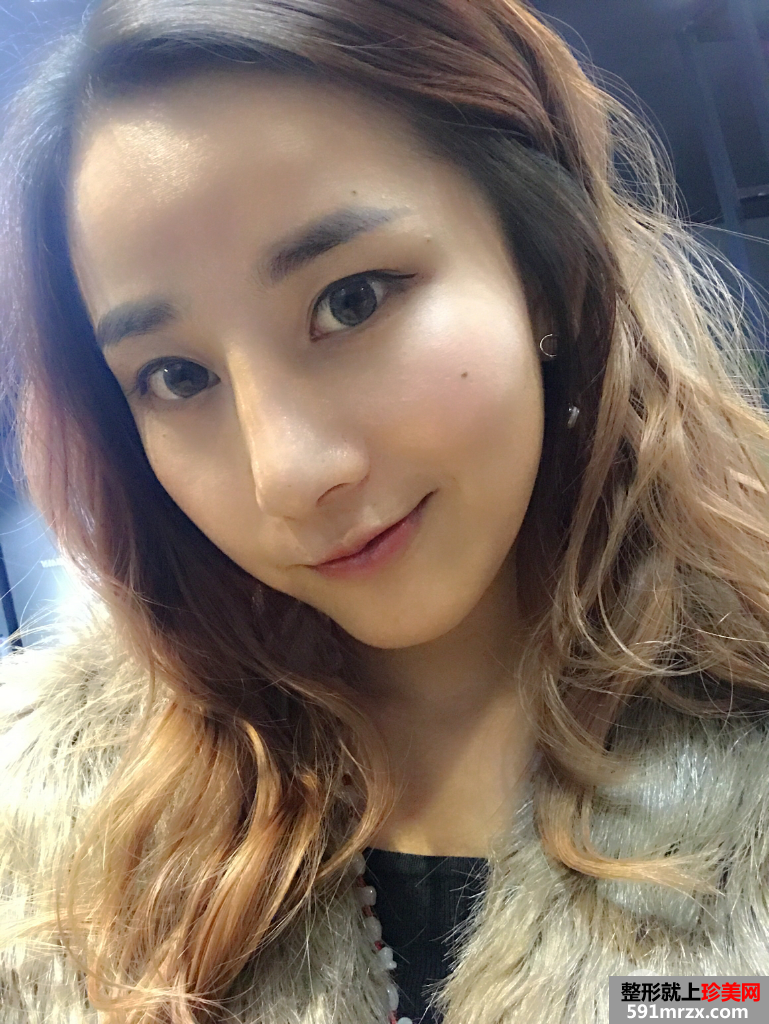隆鼻修复+自体脂肪移植填充心得体会，效果对比图分享