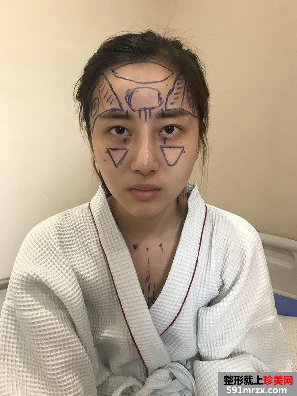隆鼻修复+自体脂肪移植填充心得体会，效果对比图分享