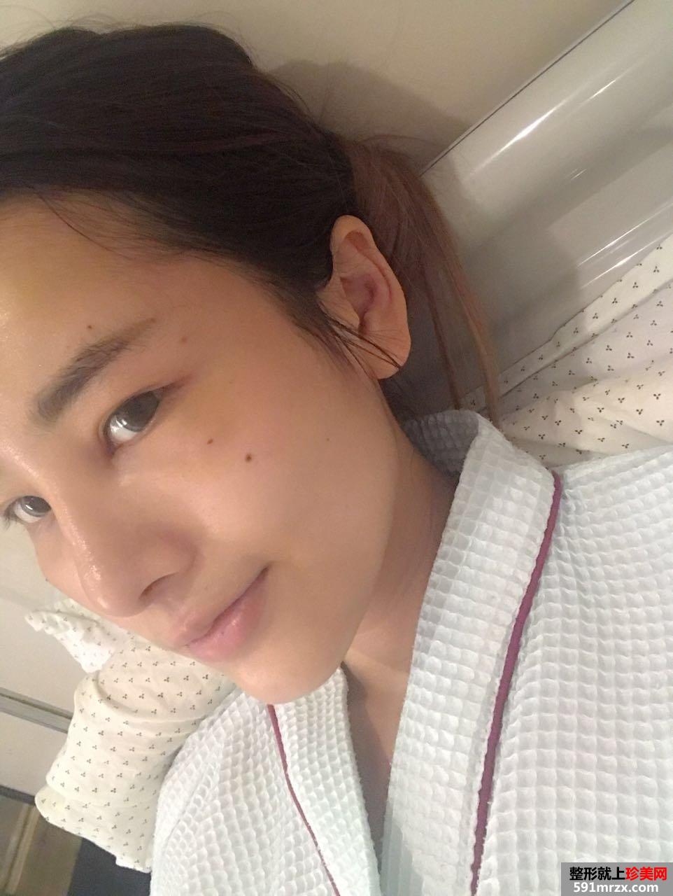 隆鼻修复+自体脂肪移植填充心得体会，效果对比图分享