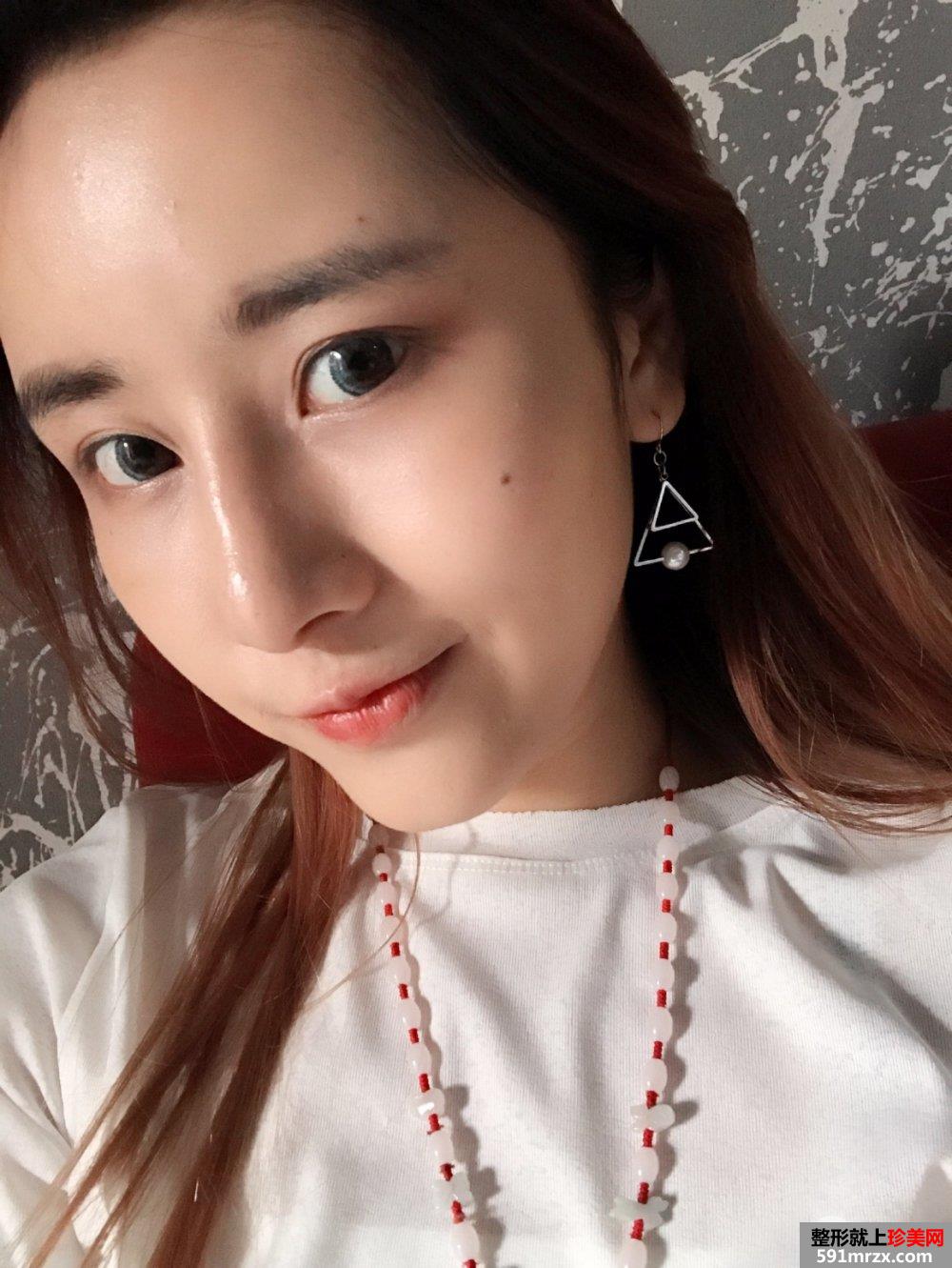 隆鼻修复+自体脂肪移植填充心得体会，效果对比图分享