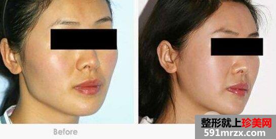 女人后缩下颌角整形价格多少，磨下颌角前后对比图