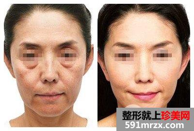 冰电波拉皮好吗、冰电波拉皮价格多少