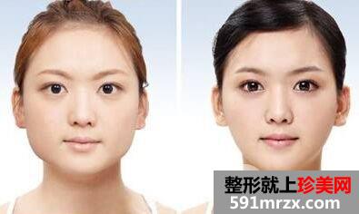 去咬肌手术多少钱|注射瘦脸价格多少