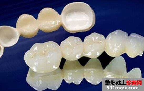 烤瓷牙的种类有哪些、烤瓷牙价格多少