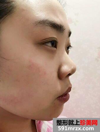 北京隆鼻手术要多少钱|鼻综合真人案例对比图