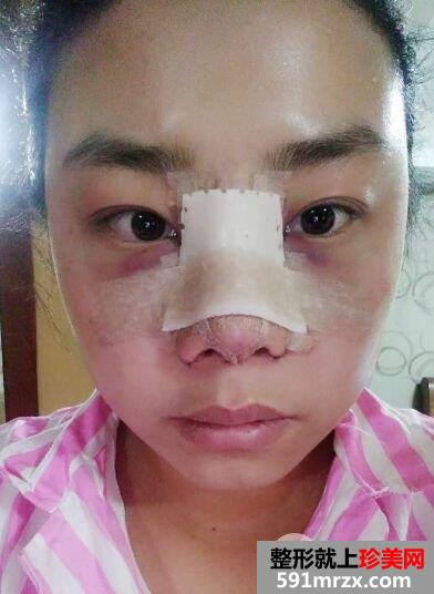 北京隆鼻手术要多少钱|鼻综合真人案例对比图