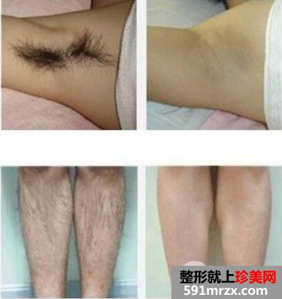 全身脱毛要多少钱，永久脱毛效果对比图