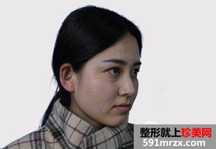 上海时光祛斑手术多少钱|激光祛斑真实案例对比照片分享