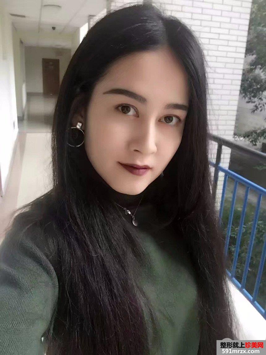 上海时光祛斑手术多少钱|激光祛斑真实案例对比照片分享