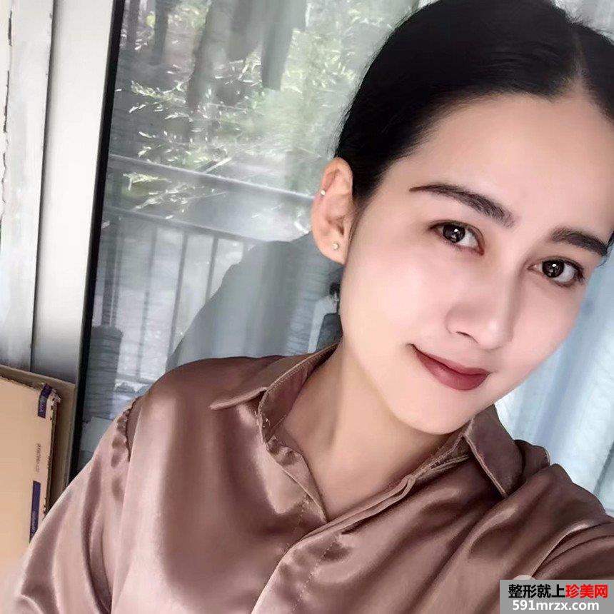 上海时光祛斑手术多少钱|激光祛斑真实案例对比照片分享