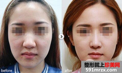 鼻头缩小手术费用详解，鼻头缩小案例对比图