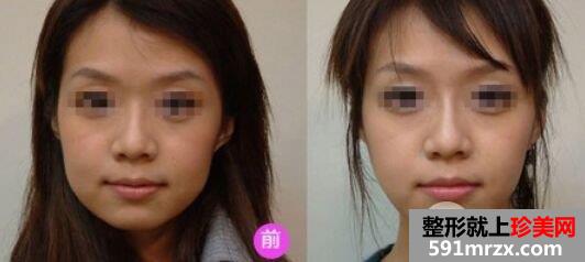 瘦脸手术价格具体多少，瘦脸前后对比照片