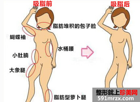 上海吸脂减肥价格表一览曝光