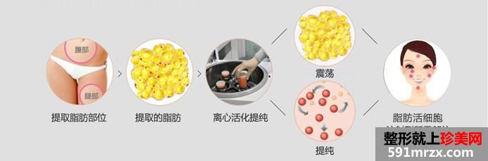 上海自体脂肪填充价格表一览曝光