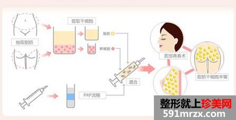 上海自体脂肪填充价格表一览曝光