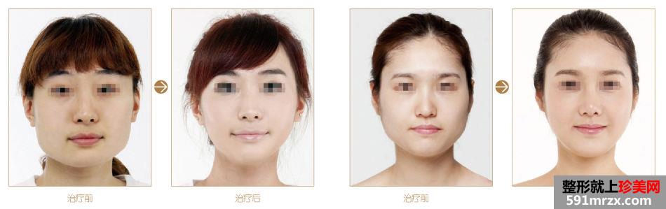 上海面部提升价格表一览曝光