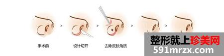 上海鼻翼缩小手术价格曝光