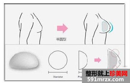 上海假体隆胸手术价格一览曝光