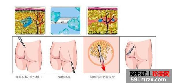 上海臀部抽脂减肥手术价格一览曝光