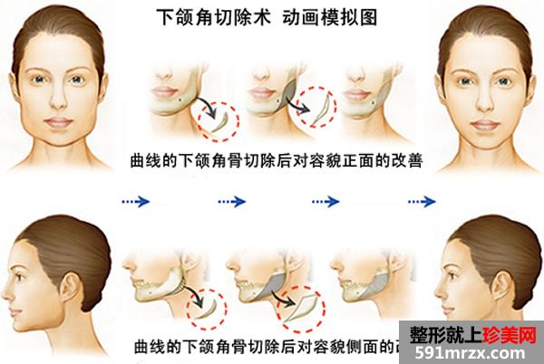 北京下颌角整形价格一览曝光
