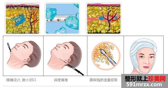 上海臀部抽脂减肥手术价格一览曝光