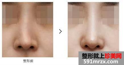 王会勇鼻整形多少钱费用价格一览