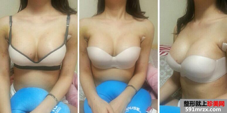 自体脂肪隆胸真实案例对比图