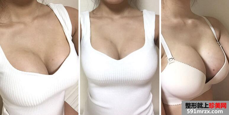 自体脂肪隆胸真实案例对比图