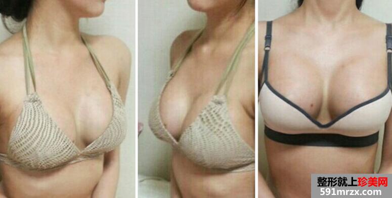 自体脂肪隆胸真实案例对比图