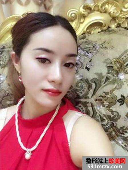假体隆鼻真实案例效果对比图