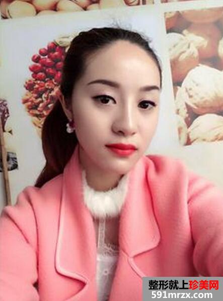 假体隆鼻真实案例效果对比图