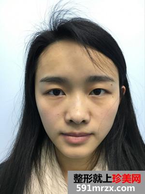 我的双眼皮整形效果恢复之旅