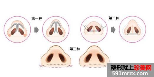 深圳做鼻翼缩小手术大概多少钱