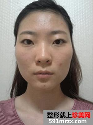 一起来,看看我,下颌角,磨骨,垫下巴,恢复,过程