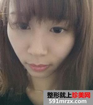 分享,削骨手术后,恢复过程