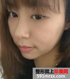 分享,削骨手术后,恢复过程