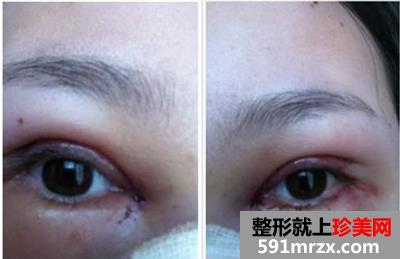 北京,安贞,医院,李斌斌,双眼皮,好不好,看看,就知道