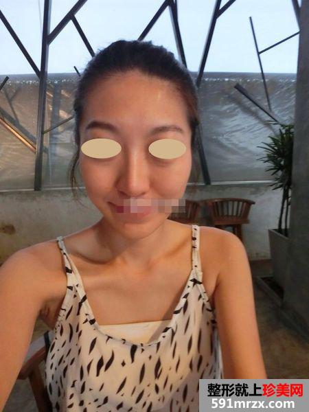 注射玻尿酸隆鼻 我的鼻子越来越漂亮了