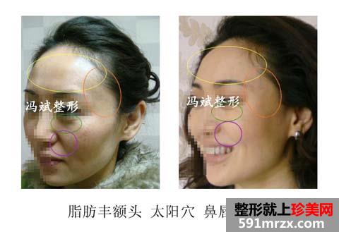 北京,东方和谐,冯斌,面部,吸脂,怎么样,案例
