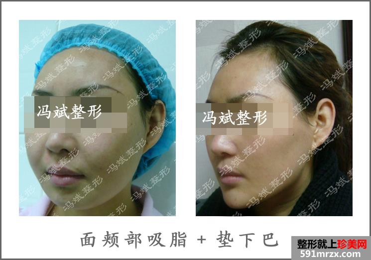 北京,东方和谐,冯斌,面部,吸脂,怎么样,案例