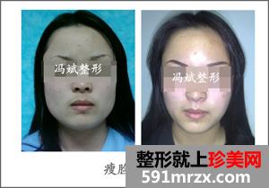 北京,东方和谐,冯斌,面部,吸脂,怎么样,案例