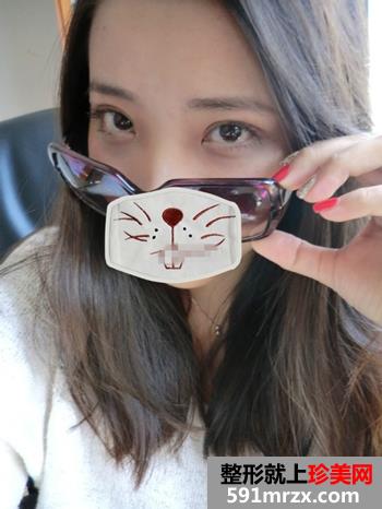 欧式,双眼皮,手术,真实,效果图,恢复,过程,案例
