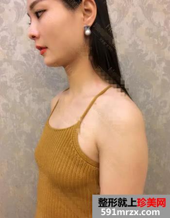 妙桃,琴面,假体,隆胸,手术,恢复,过程,真实,效果,照片,分享
