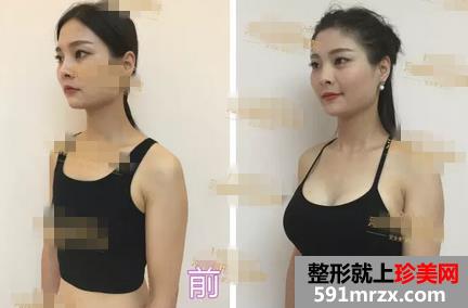 妙桃,琴面,假体,隆胸,手术,恢复,过程,真实,效果,照片,分享