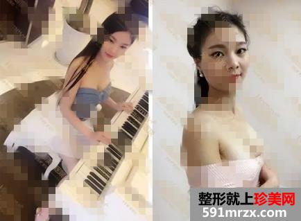 妙桃,琴面,假体,隆胸,手术,恢复,过程,真实,效果,照片,分享